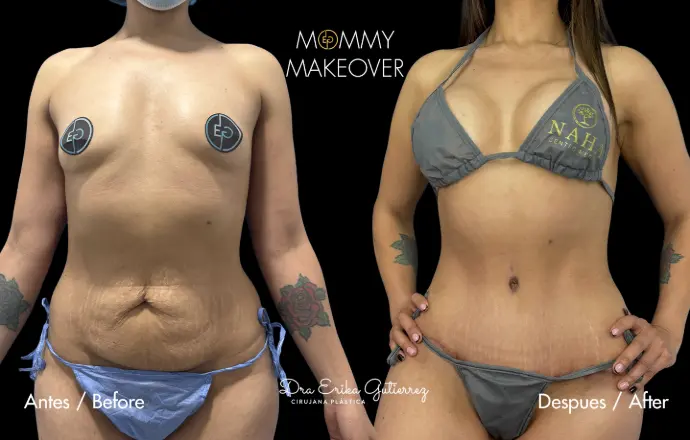 Antes y despues de mommy make over con  implantes mamamrios. Dra. Erika gutierrez. Bogota. Colombia