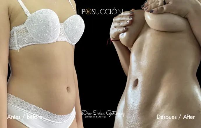 Resultado antes y despues lipoescultura con marcación dra erika gutierrez. bogota