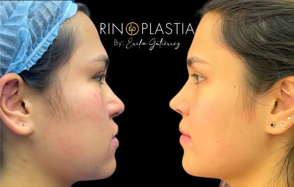 Rinomodelación femenina