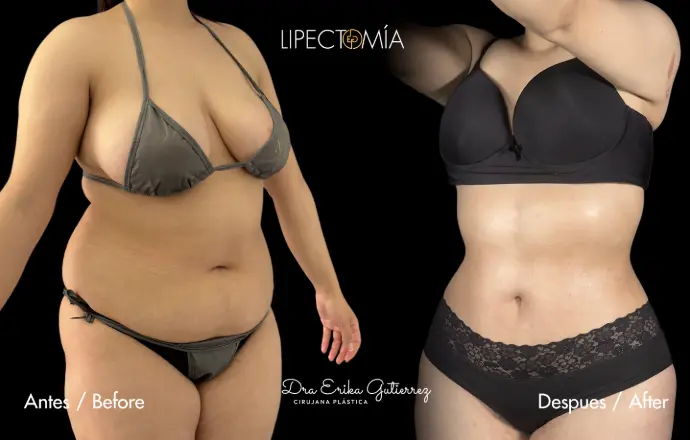 Mommy make over, lipectomia dra erika gutierrez Bogota Colombia