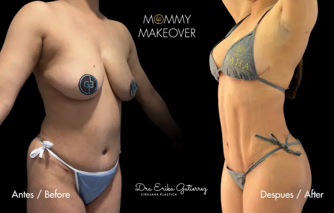 Antes y despues mommy make over con liposucción y pexia en t invertida. Dra Erika gutierrez