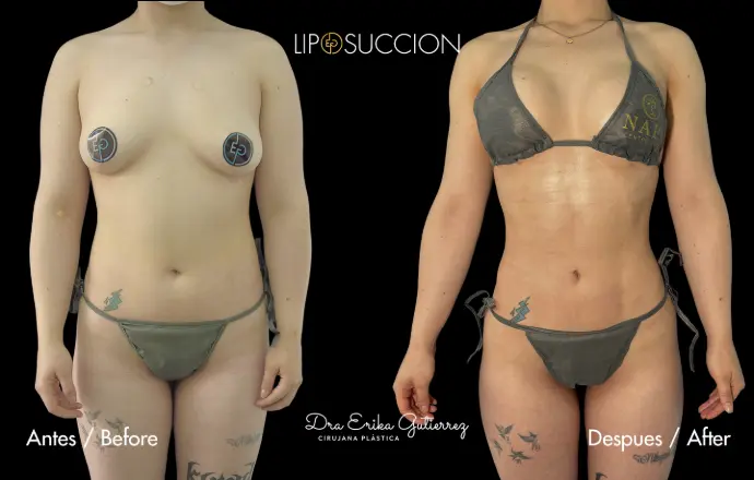 Resultado antes y despues lipoescultura sin marcación  con lipoinyeccióndra erika gutierrez. bogota