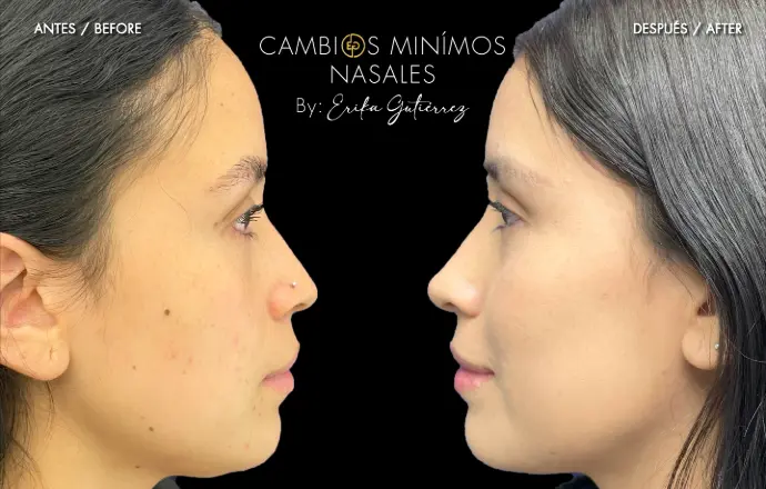 Antes y despues perfilamiento nasal, Dra. Erika Gutiérrez - Cirujana plástica estética y reconstructiva- Bogotá - Colombia