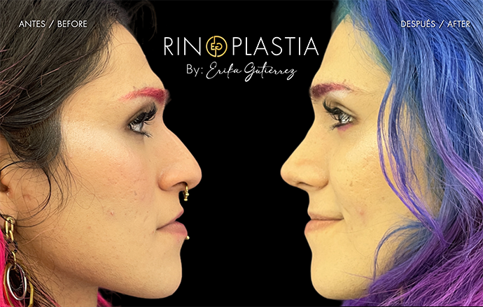 Rinoplastia