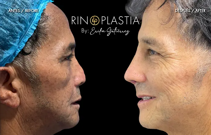 Rinoplastia secundaria
