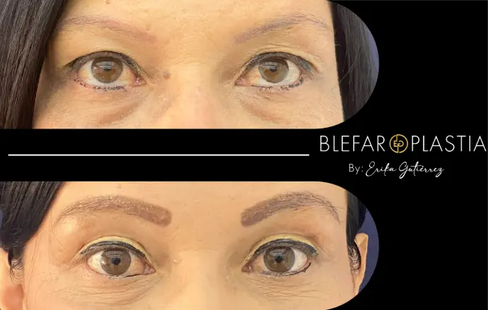 Blefaroplastia