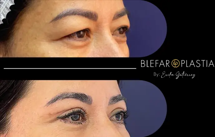 Blefaroplastia