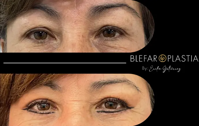 Blefaroplastia