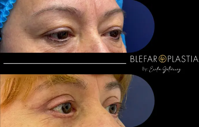 Blefaroplastia