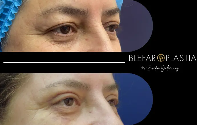 Blefaroplastia