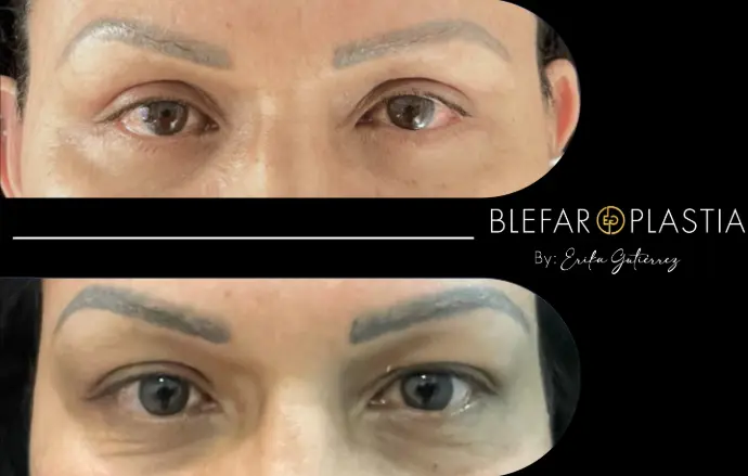 Blefaroplastia