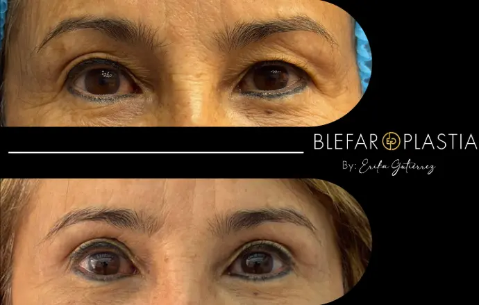 Blefaroplastia