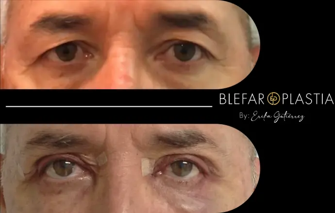Blefaroplastia