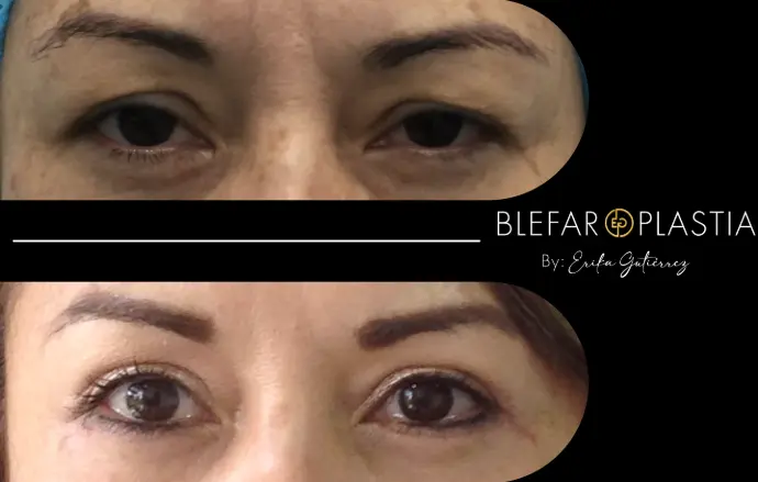 Blefaroplastia