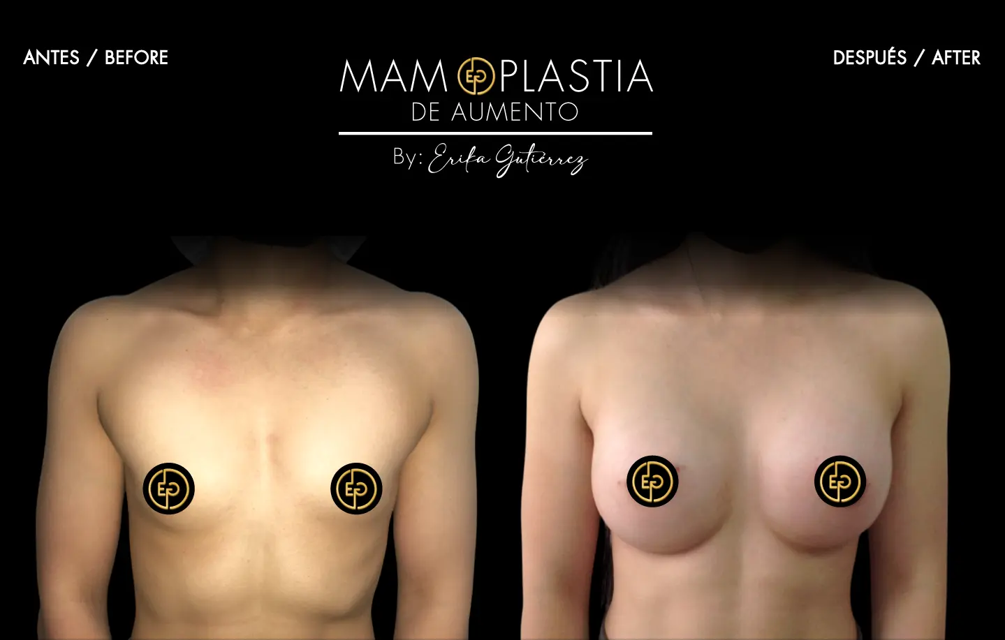 Mamoplastia de aumento