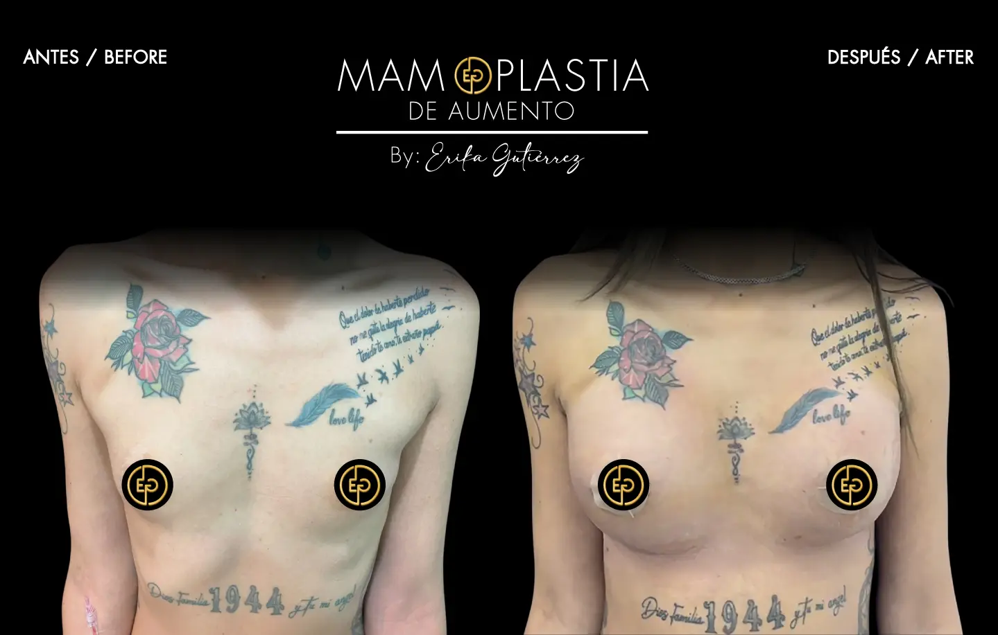 Mamoplastia de aumento
