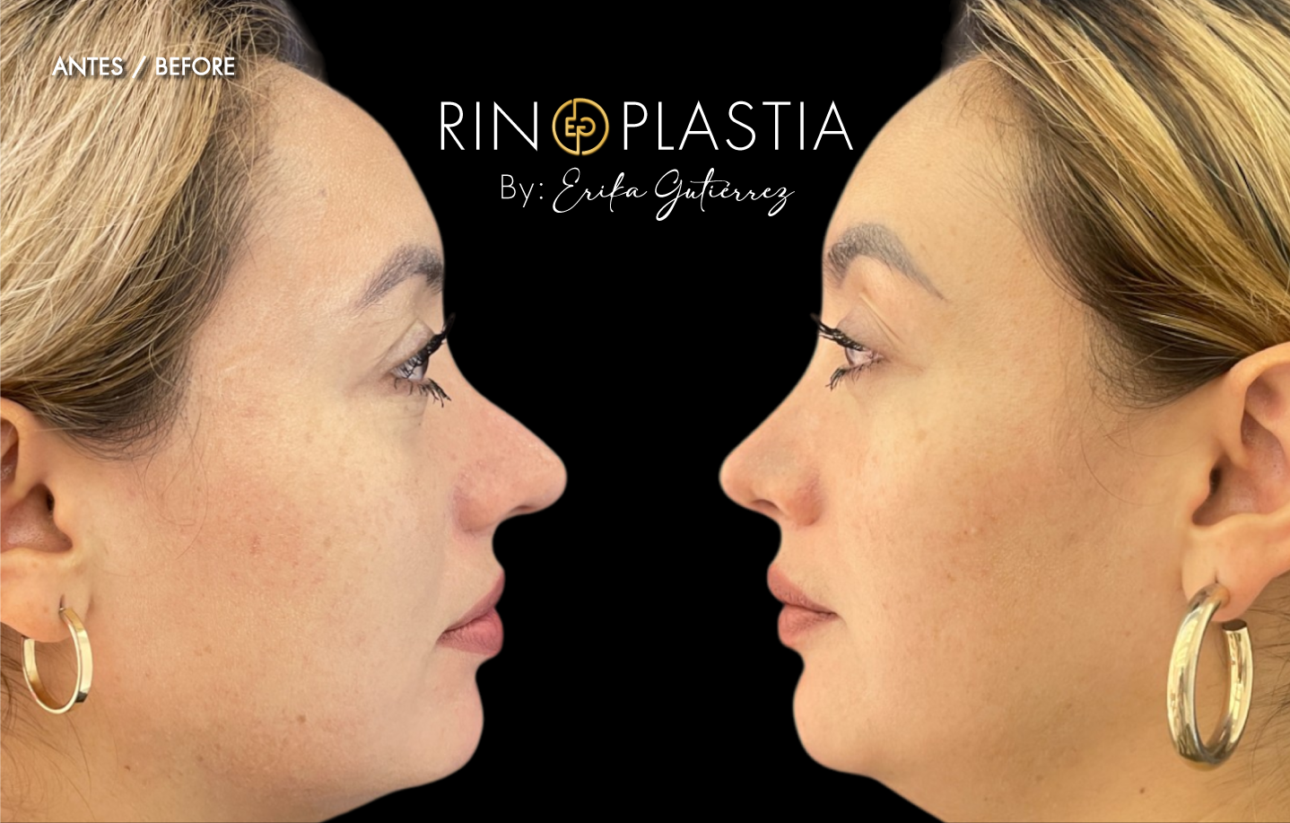 Rinoplastia secundaria
