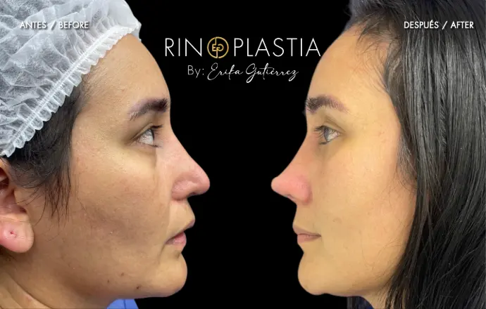 Rinoplastia secundaria