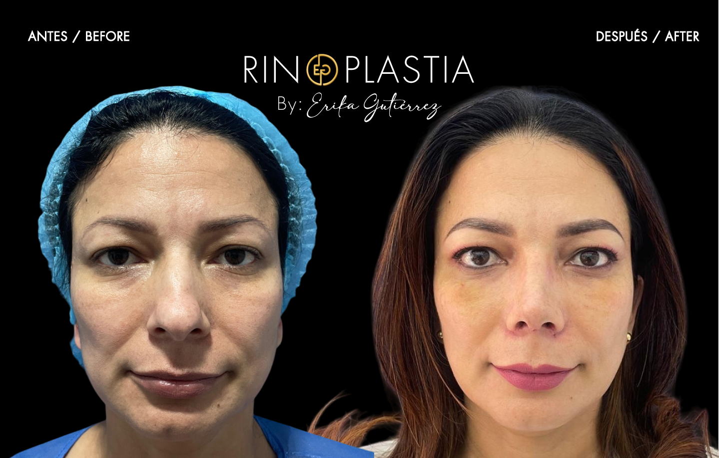 Rinoplastia