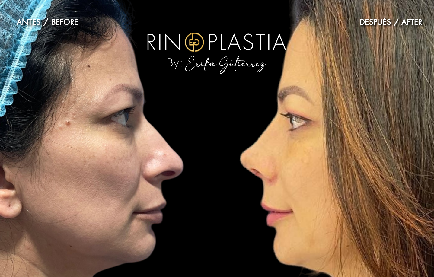Rinoplastia