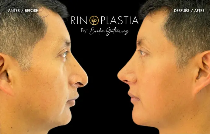 Rinoplastia