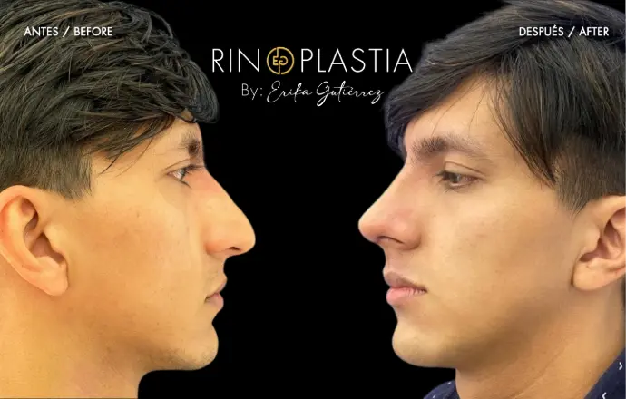 Rinoplastia