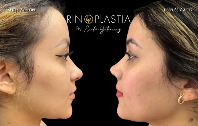 Rinoplastia