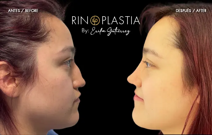 Rinoplastia