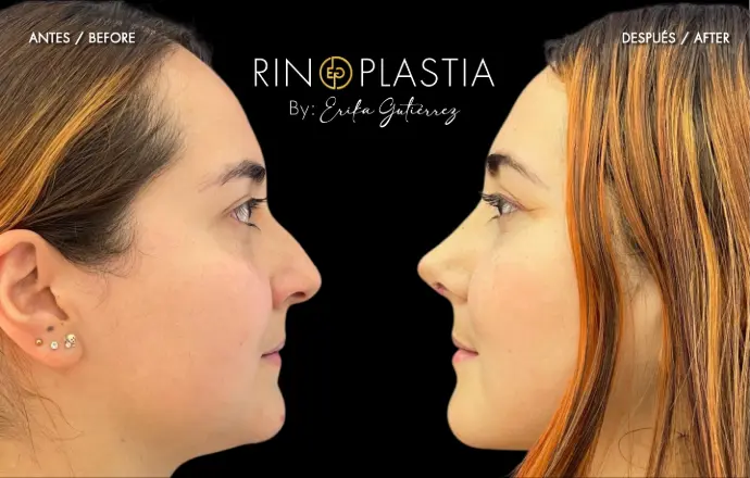 Rinoplastia