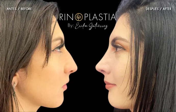 Rinoplastia