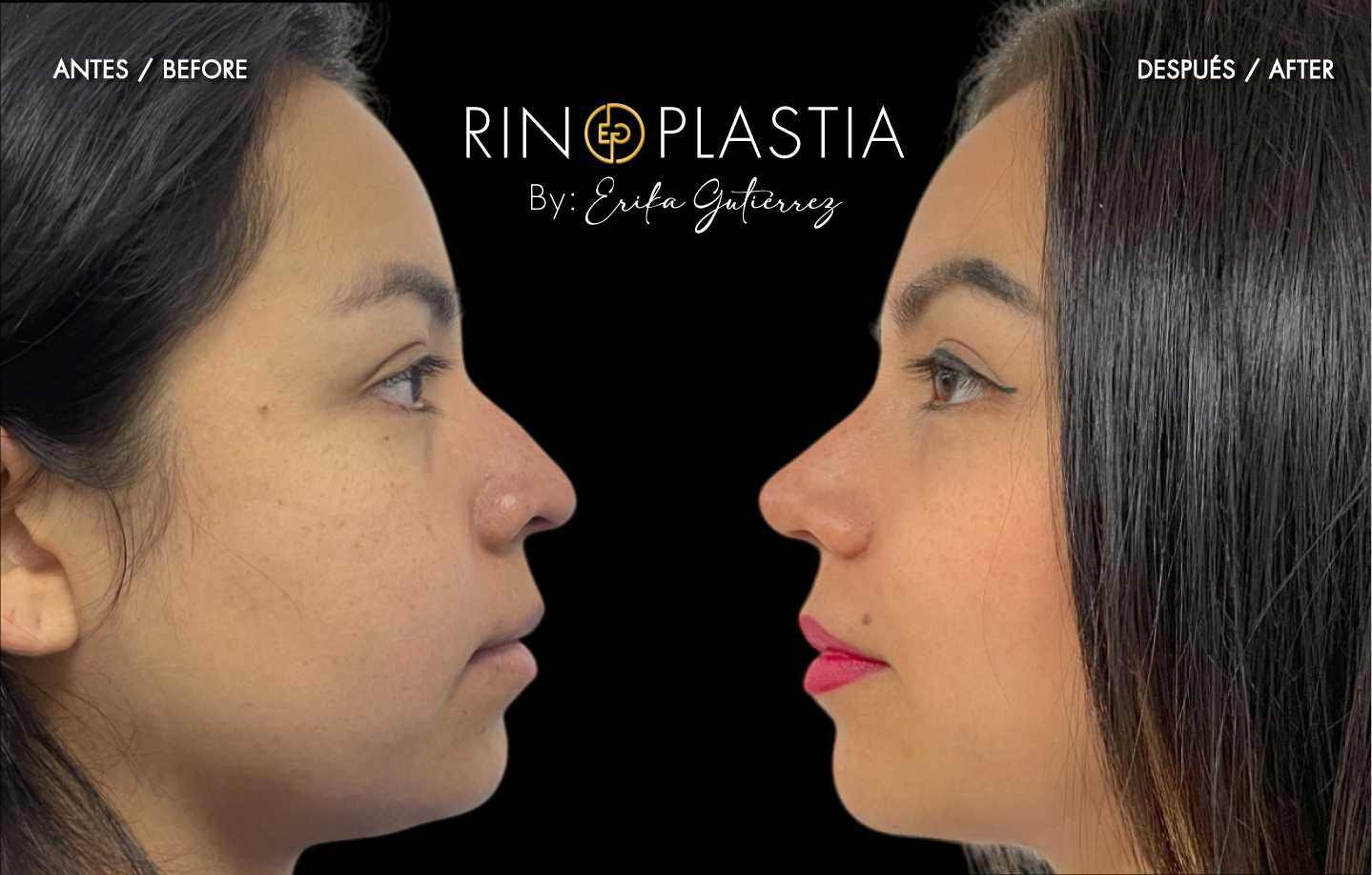 Rinoplastia