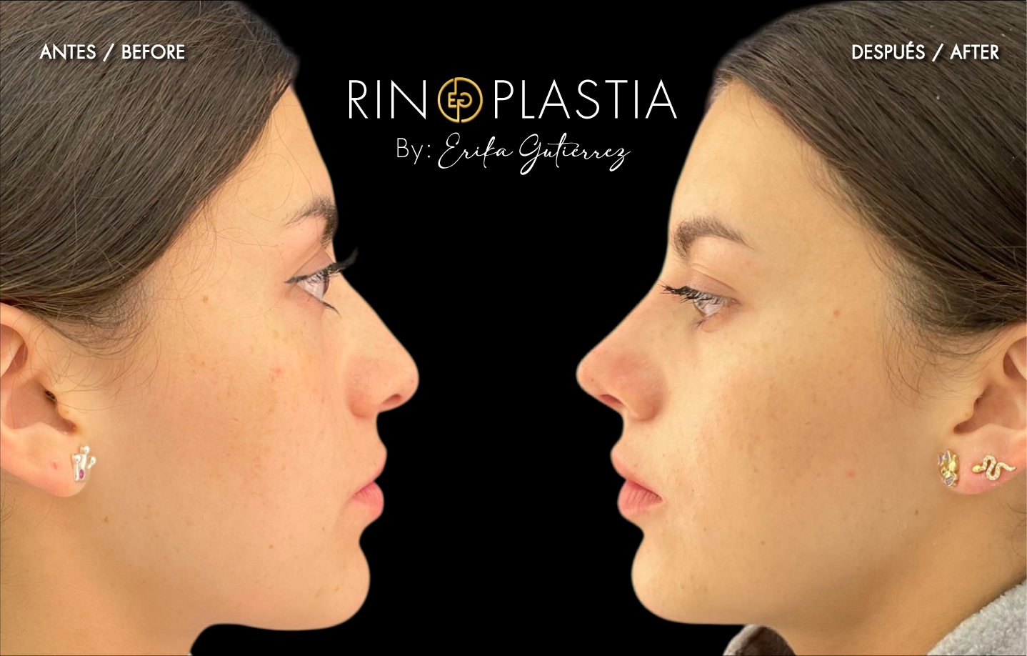 Rinoplastia