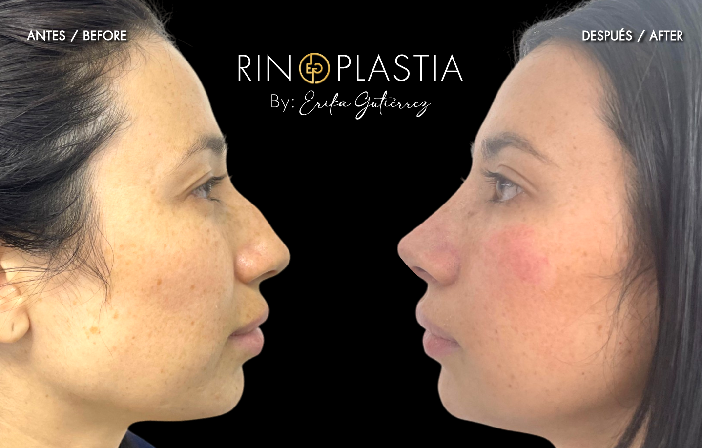 Rinoplastia