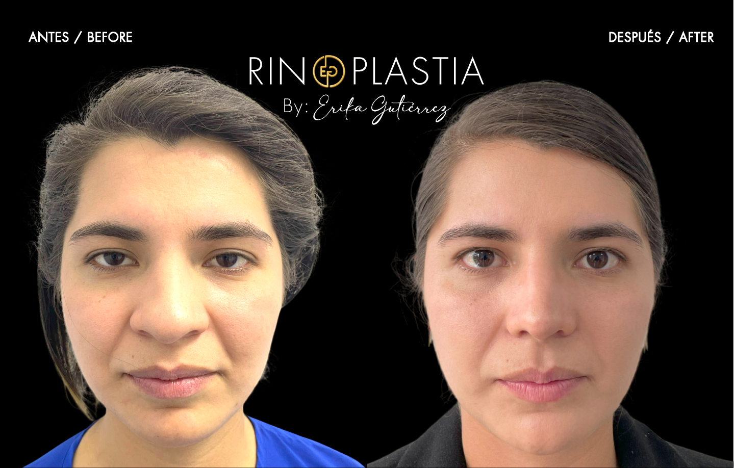 Rinoplastia