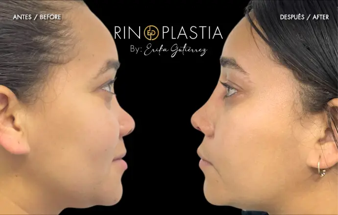 Rinoplastia
