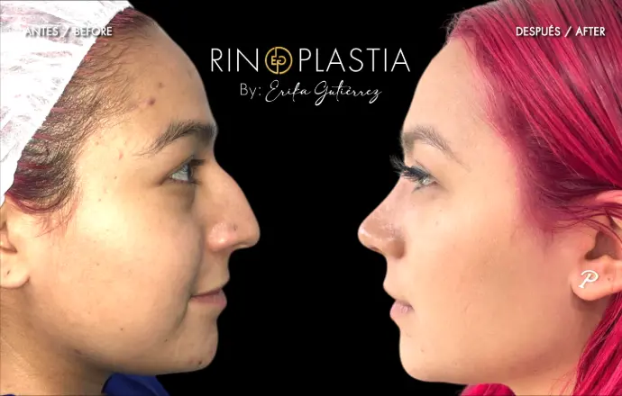 Rinoplastia