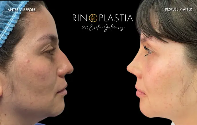 Rinoplastia