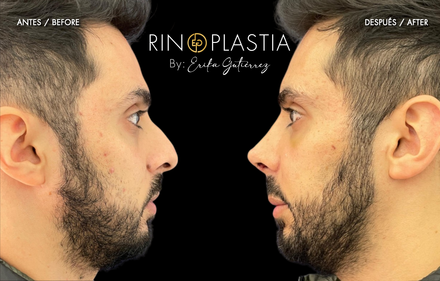 Rinoplastia