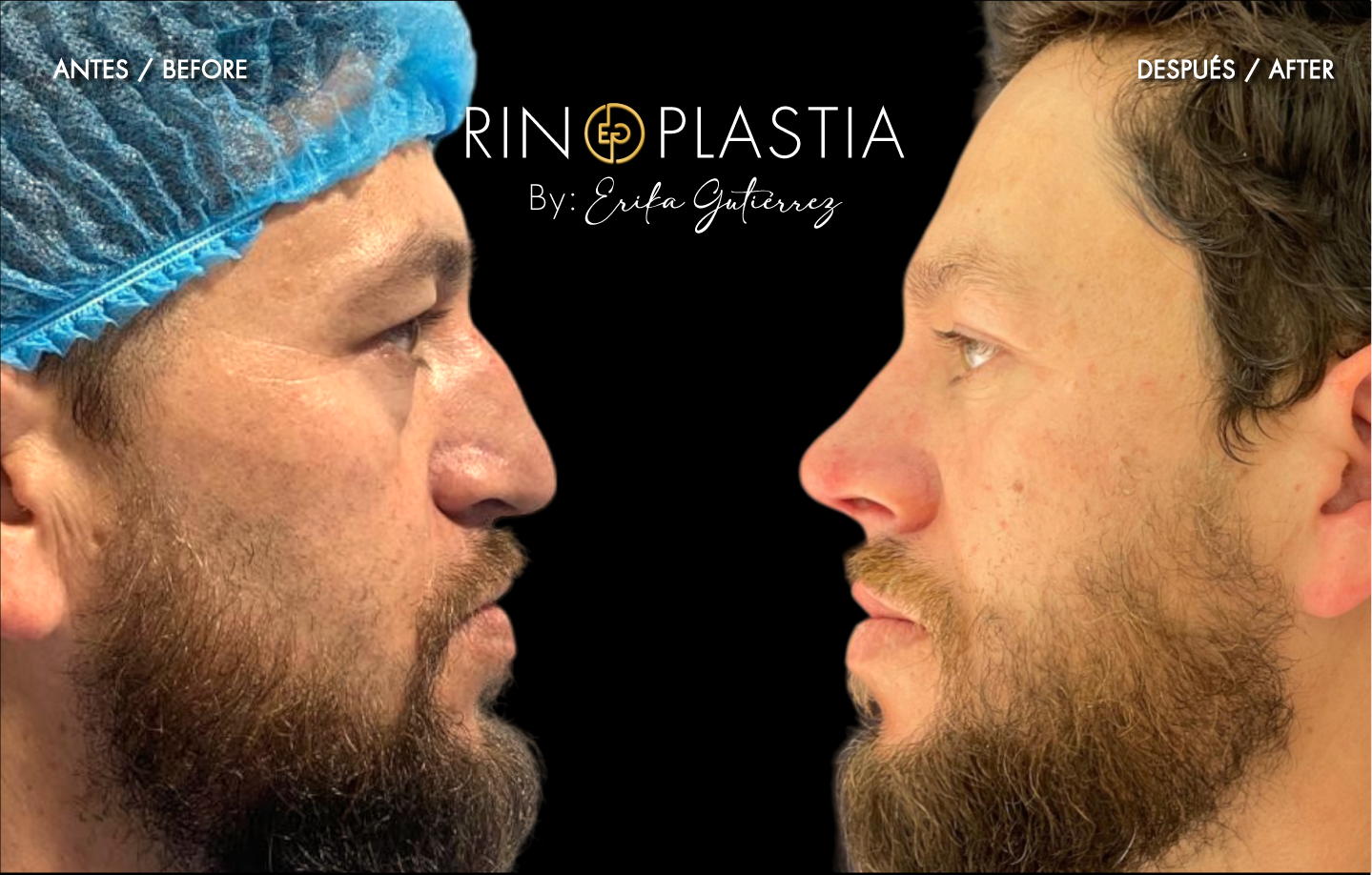 Rinoplastia