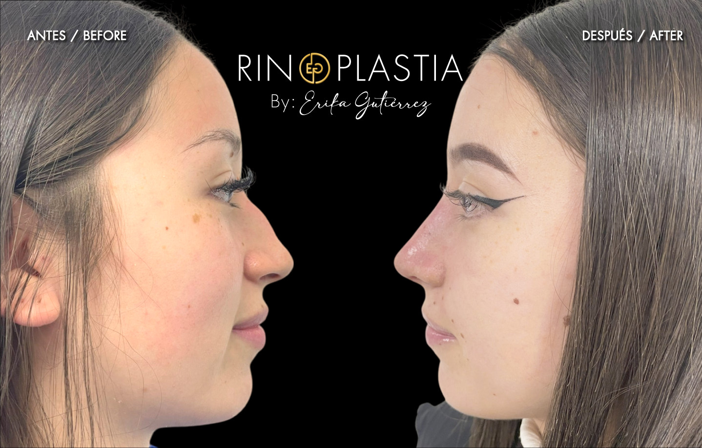 Rinoplastia