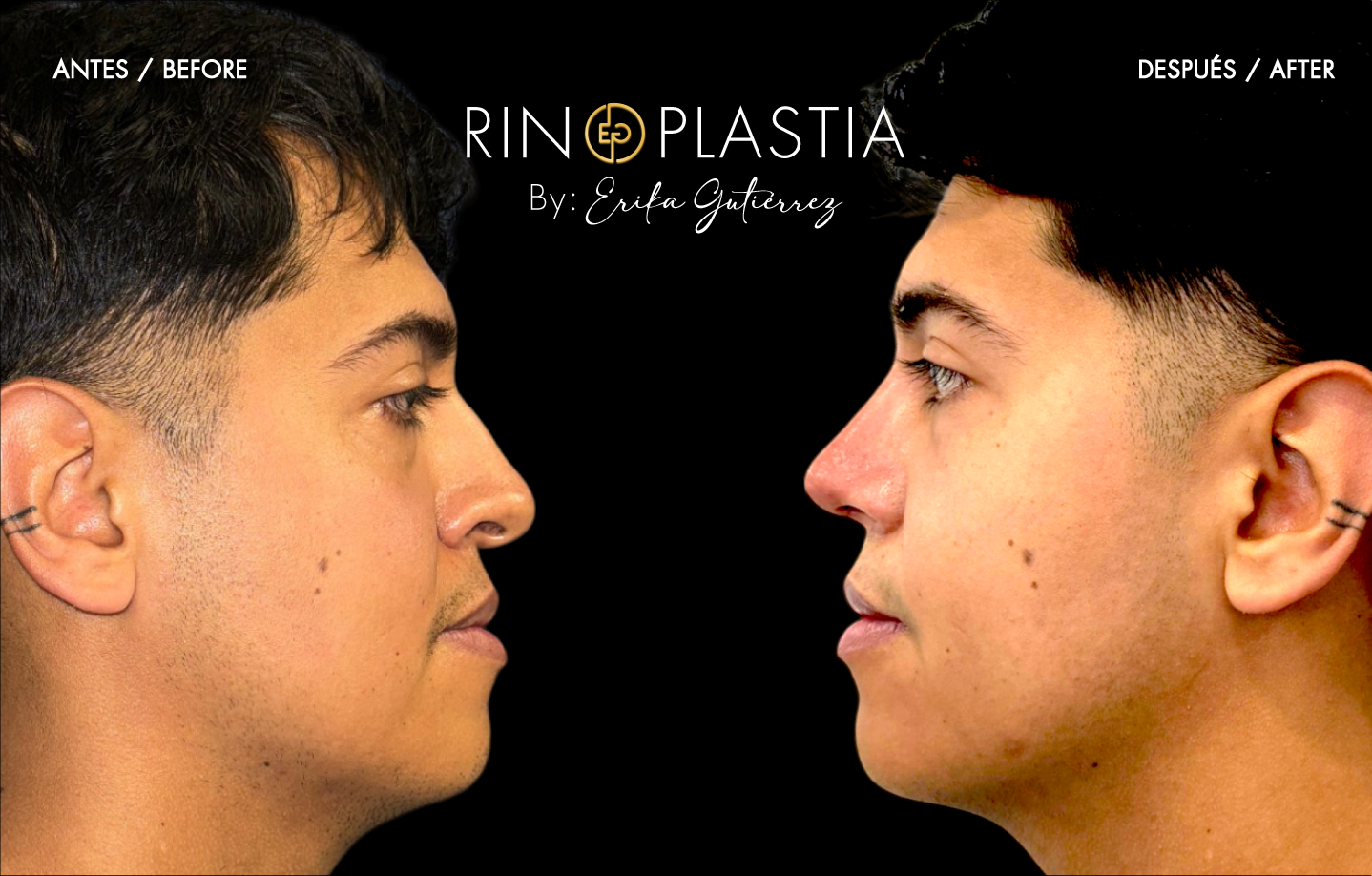 Rinoplastia