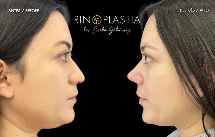 Rinoplastia