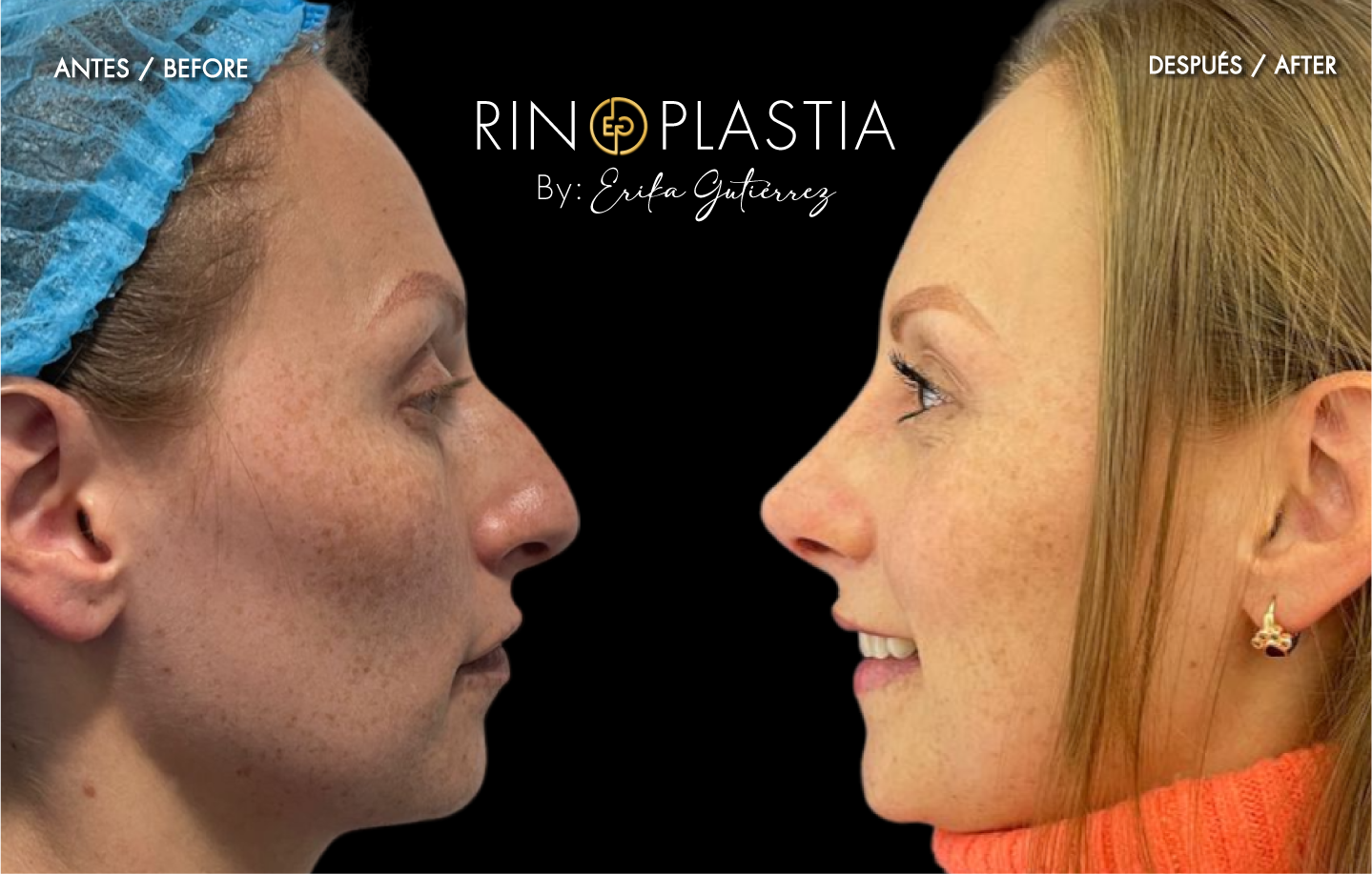 Rinoplastia