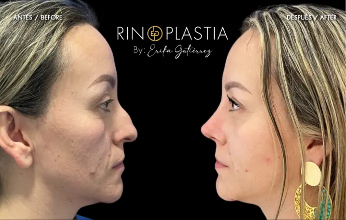 Rinoplastia