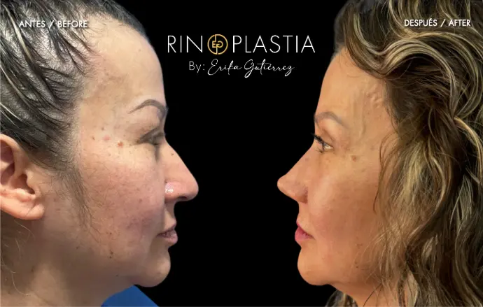 Rinoplastia
