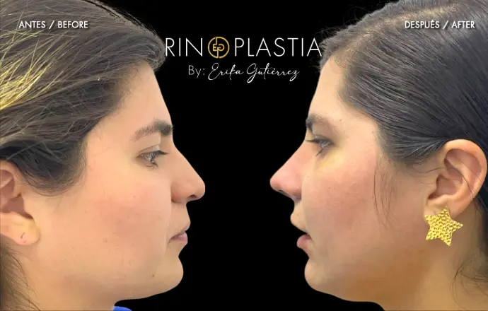 Rinoplastia